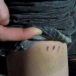 Wounds Inflicted by Philadelphia Bike Police at Occupy Philadelphia