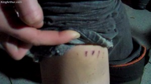 Wounds Inflicted by Philadelphia Bike Police at Occupy Philadelphia